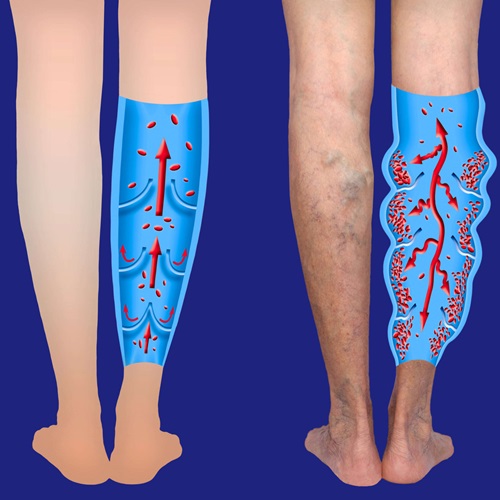 Laser Varicose Veins Training Manufacturers in Ahmedabad